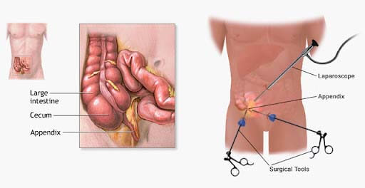 appendix surgery in mumbai