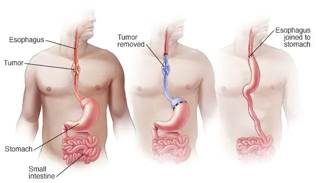 esophagectomy (esophageal surgery) in mumbai