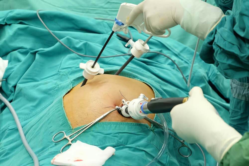 laparoscopic cholecystectomy in mumbai