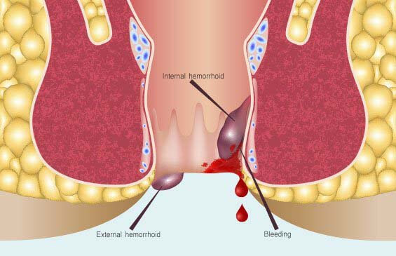 piles surgery for mumbai | hemorrhoidectomy