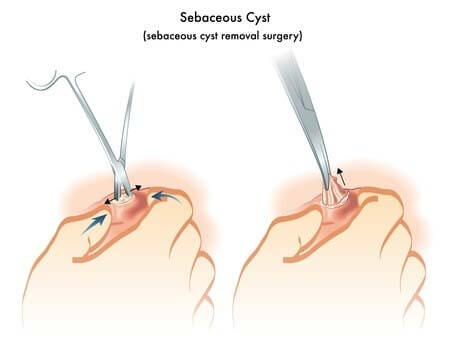 sebaceous cyst excision in mumbai