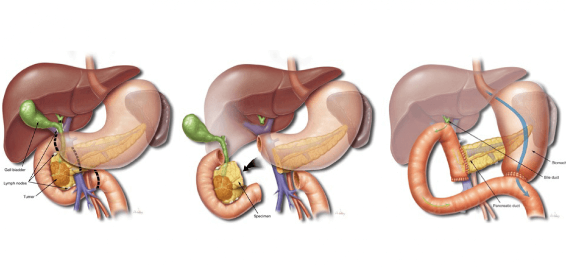 whipple procedure (pancreaticoduodenectomy) in mumbai